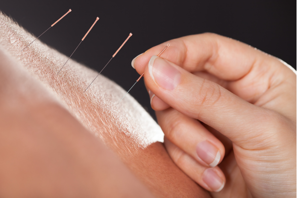 Can Acupuncture Help with Chronic Back Pain? What the Research Says
