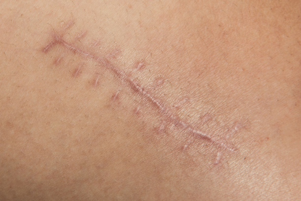 How to Reduce Scars and Pigmentation After Your TKR Surgery: A Simple Guide for Indian Patients