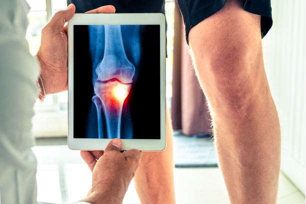 The Role of Senescence-Associated Secretory Phenotype (SASP) in Osteoarthritis Progression